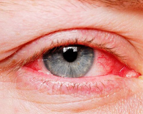 Những hiểu biết cơ bản về bệnh đau mắt đỏ
