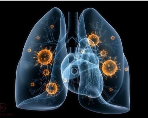 Bệnh lao phổi có thực sự đáng sợ? Những di chứng khi mắc bệnh lao phổi