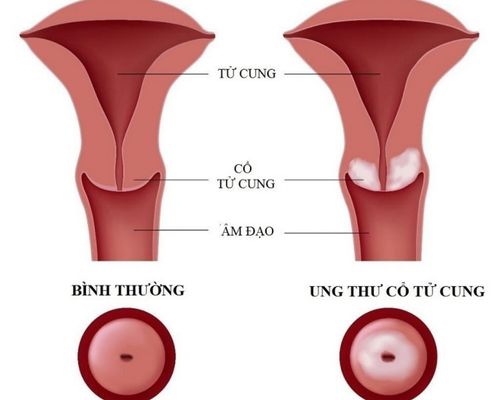 dau-hieu-ung-thu-co-tu-cung