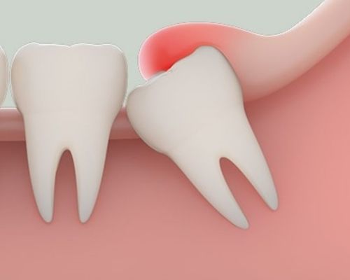 Tại sao lại đau răng khôn? Cách làm giảm đau răng khôn