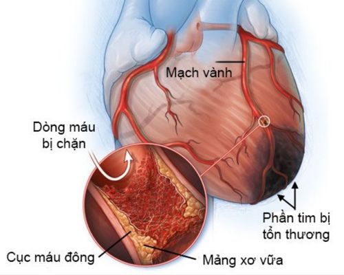 Thiếu máu cơ tim nguy hiểm như thế nào? Cách phòng tránh thiếu máu cơ tim