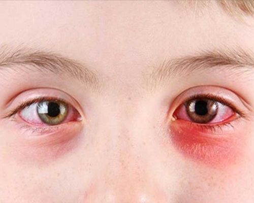 Bị đau mắt hột: triệu chứng, nguyên nhân và cách điều trị bệnh