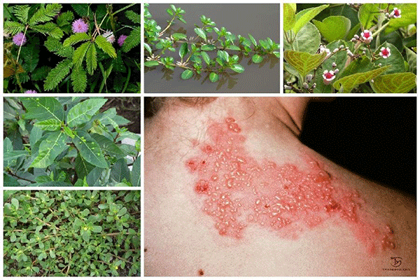 Tổng hợp phương pháp dân gian chữa zona thần kinh đơn giản & hiệu quả